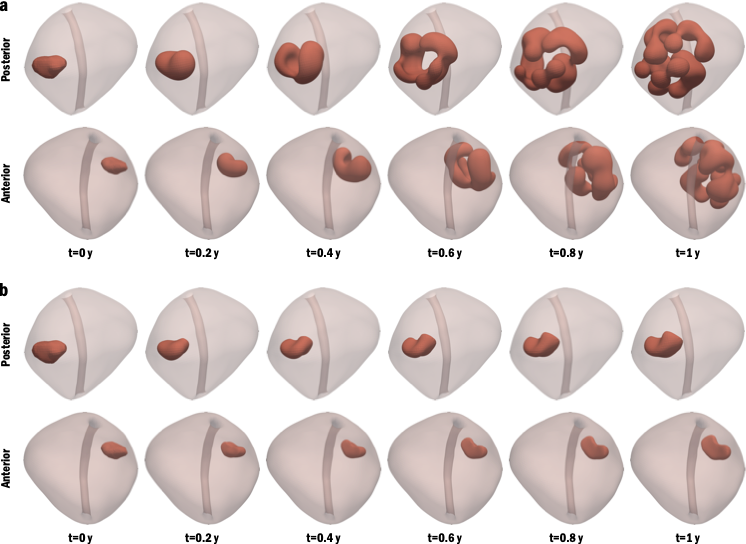 Tumori alla prostata: una simulazione al computer per comprenderne la crescita