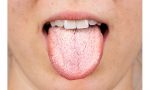 La candida orale colpisce bocca e lingua