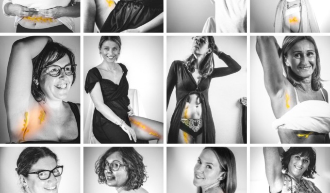 Al CNAO di Pavia una mostra fotografica per fare luce sul melanoma