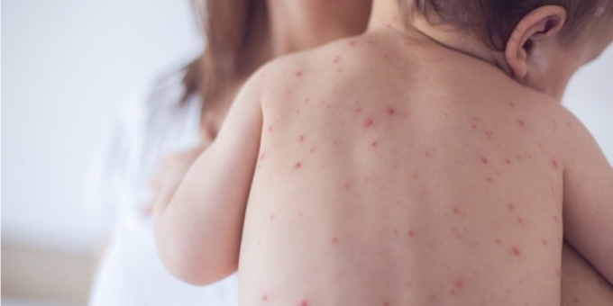 Morbillo, aumentano i casi e torna l’allarme: programmato un Vax Day a Pavia