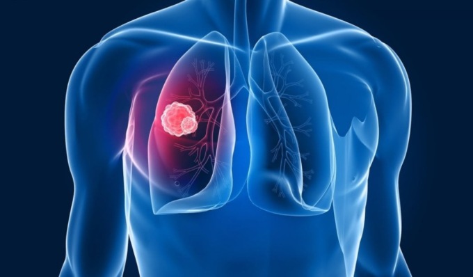 “Battere il mesotelioma” a Broni la presentazione di uno studio innovativo per prevenire la malattia