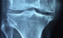 Giornata Mondiale dell’Osteoporosi 2024, specialisti del San Matteo al Broletto in un incontro aperto al pubblico