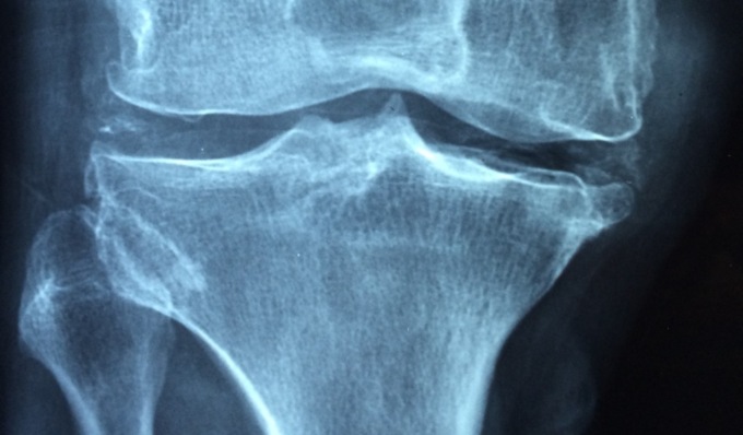 Giornata Mondiale dell’Osteoporosi 2024, specialisti del San Matteo al Broletto in un incontro aperto al pubblico