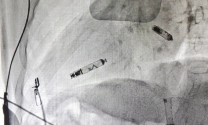 All'Ospedale di Voghera primo impianto di un pacemaker bicamerale leadless