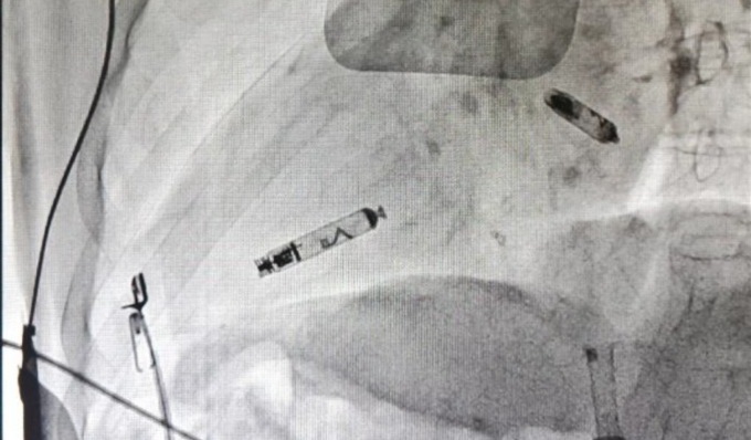 All’Ospedale di Voghera primo impianto di un pacemaker bicamerale leadless